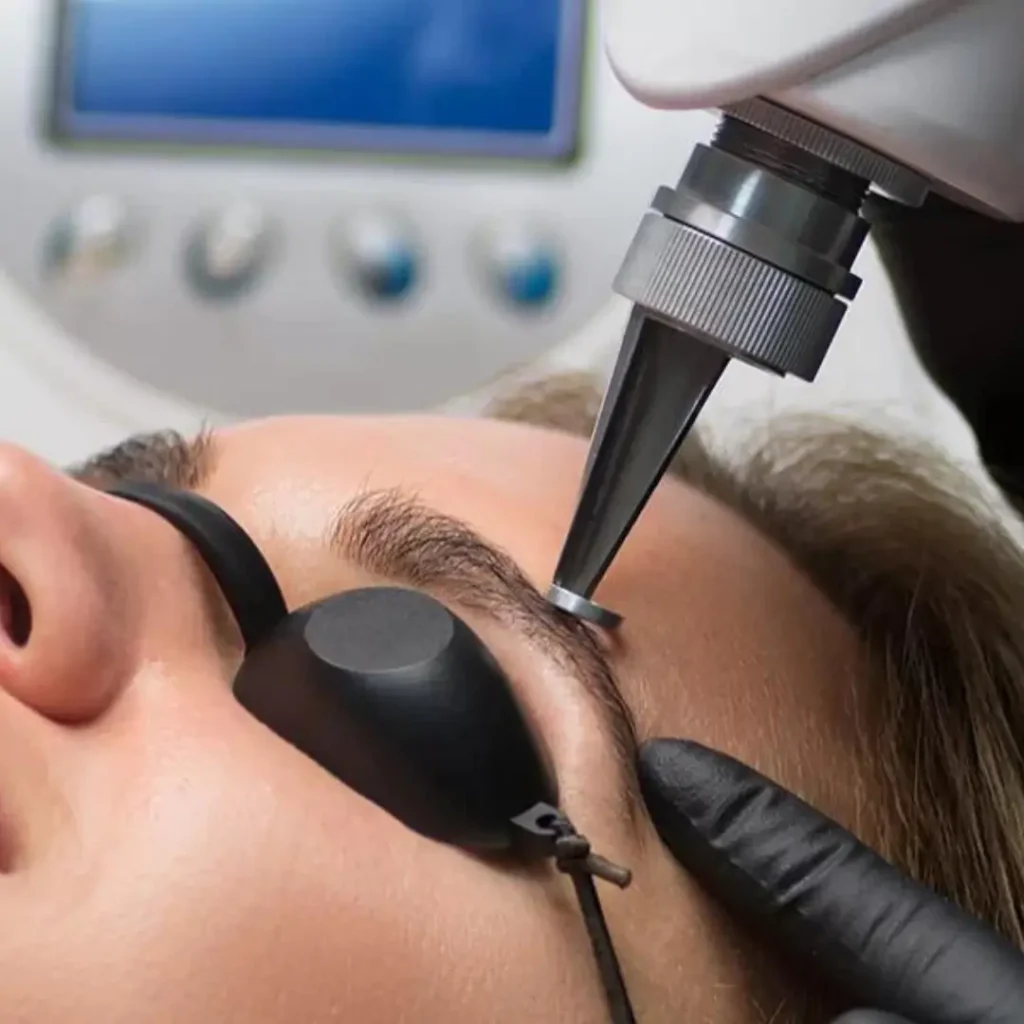 Remoción de Pigmentos